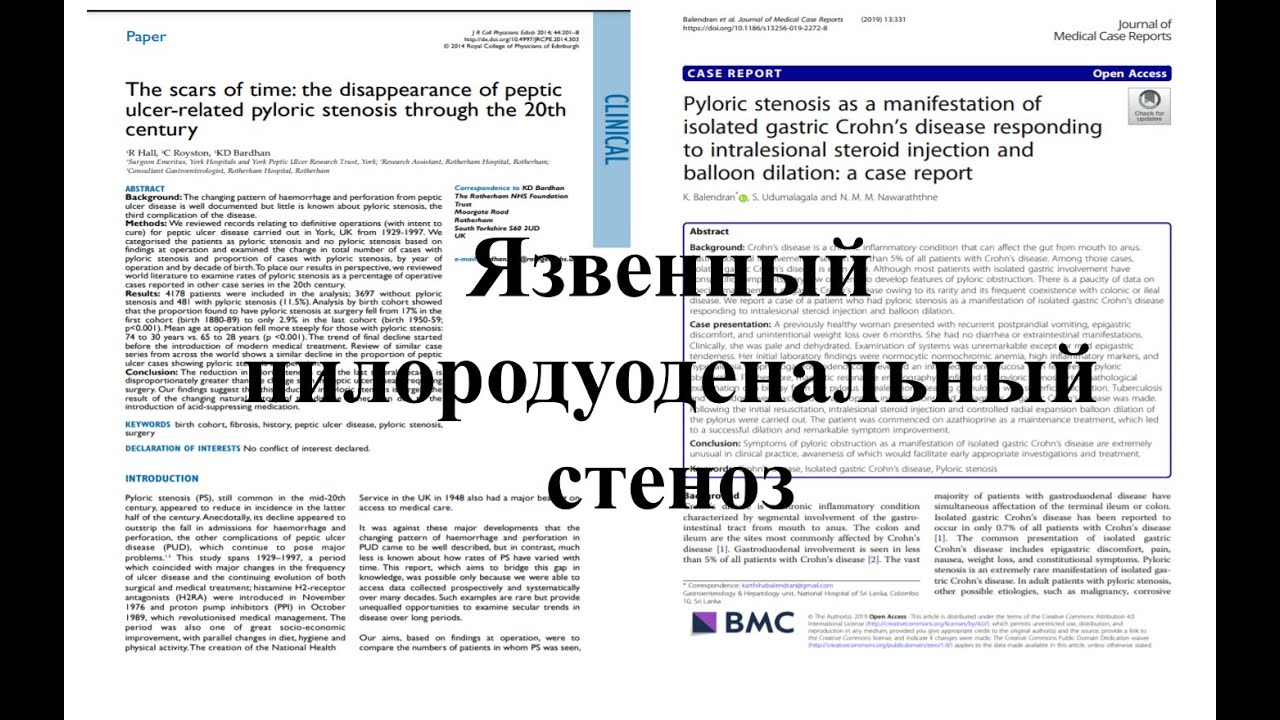 Хронические осложнения язвенной болезни желудка или ДПК. Пилородуоденальный стеноз