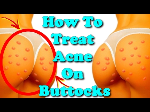 how to treat acne on buttocks