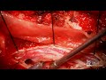 Live Surgery: Resection of Spinal Tumor - Rod J. Oskouian, M.D.