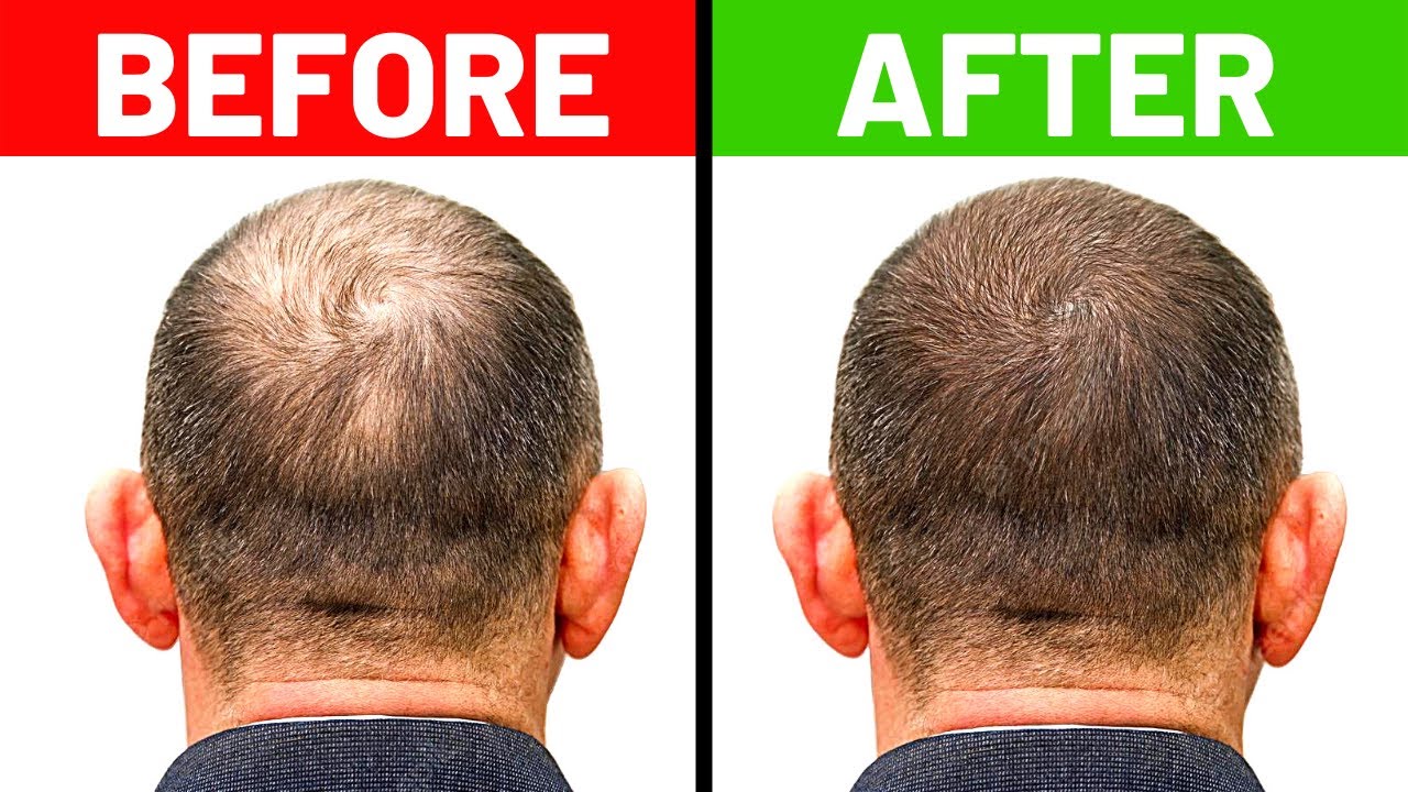 10 Home Remedies To Prevent Hair Loss and Regrow Your Hair - YouTube