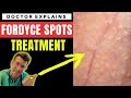 How to treat FORDYCE SPOTS - Doctor O'Donovan explains...