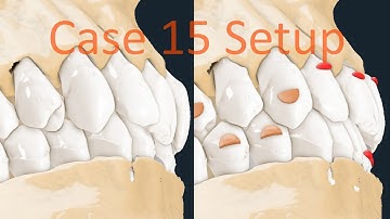 Maestro 3D aligners virtual setup: case 15, posterior crossbite and a deep bite treatment