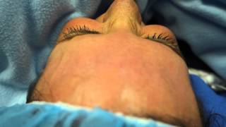 Tickle Lipo Really Tickles, Hall Plastic Surgery in Austin, Texas