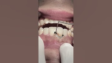 Retraction cord for class V tooth caries, The full video soon #dentist