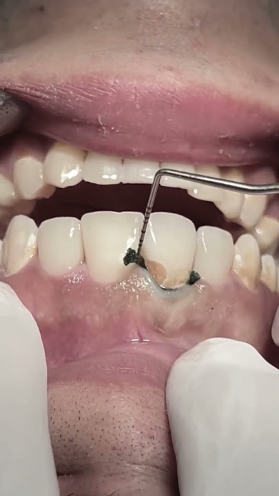 Retraction cord for class V tooth caries, The full video soon #dentist