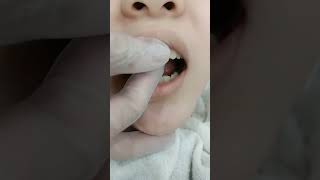 小美女刚镶的3颗全瓷牙冠，把龋坏的牙保护起来 口腔检查全瓷牙烤瓷牙