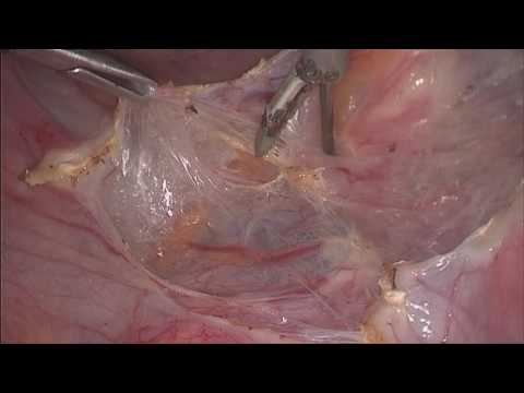 Laparoscopic Hysterectomy With Adnexe After Bilateral Ureter Dissection (no Edit)