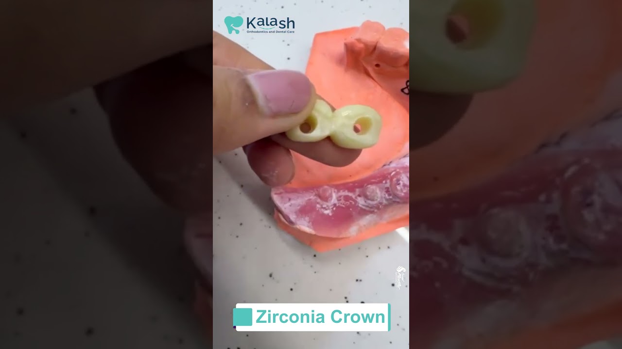 Enhance your smile with the brilliance of a zirconia crown | Kalash Orthodontics and Dental Care