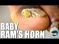 CRAZY SPLIT NAIL RAM'S HORN TOENAIL REMOVAL