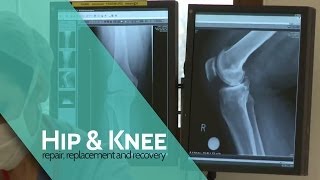 Risks of Osteotomy | Osteotomy