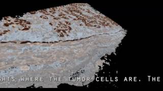ovarian cancer and its precursor in 3D