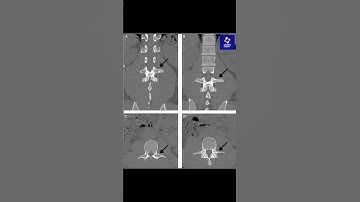 CT Scan Reveals Transverse Process Fractures 🦴📊 #backpain #trauma #meded #sportsmedicine #ATC