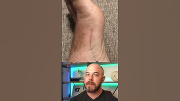 Thumbnail of Doctor reacts to MASSIVE hair splinter! #dermreacts #doctorreacts #hairsplinter