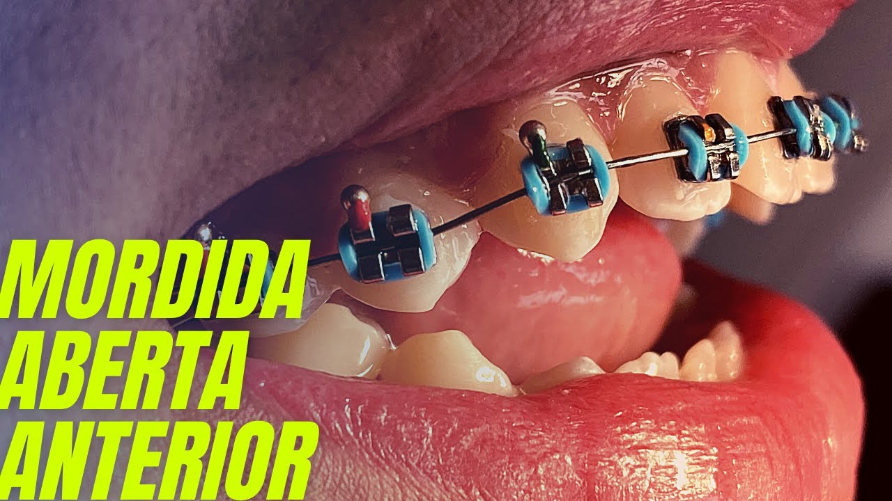 Коррекция переднего открытого прикуса | Ортодонтическое лечение