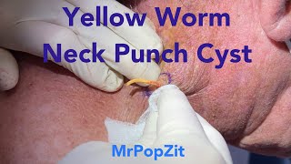 Yellow Worm Neck Punch Cyst. Cyst on neck under pressure. Big squeeze pasty cyst pop. MrPopZit