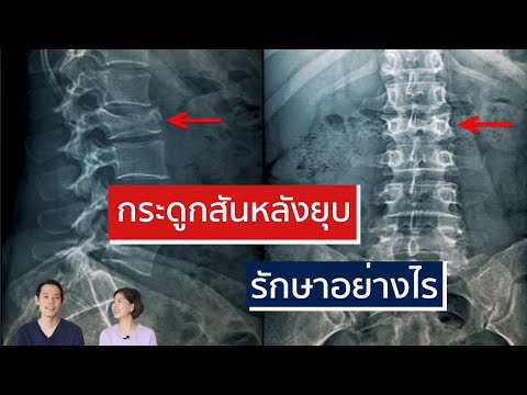 กระดูกสันหลังหักยุบในคนสูงอายุ รักษาอย่างไร | EasyDoc EP.22