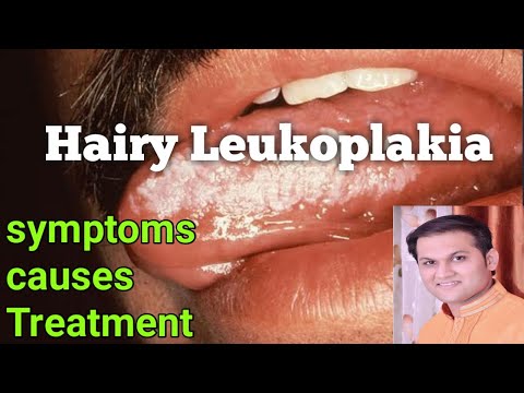 Video: Leukoplakia - Symptoms, Treatment, Simple And Hairy Leukoplakia