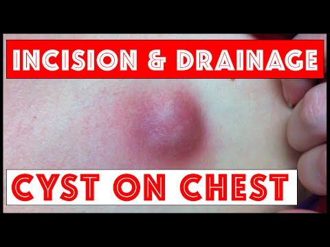 I & D (Incision & Drainage) of an Inflamed Cyst, Left Chest