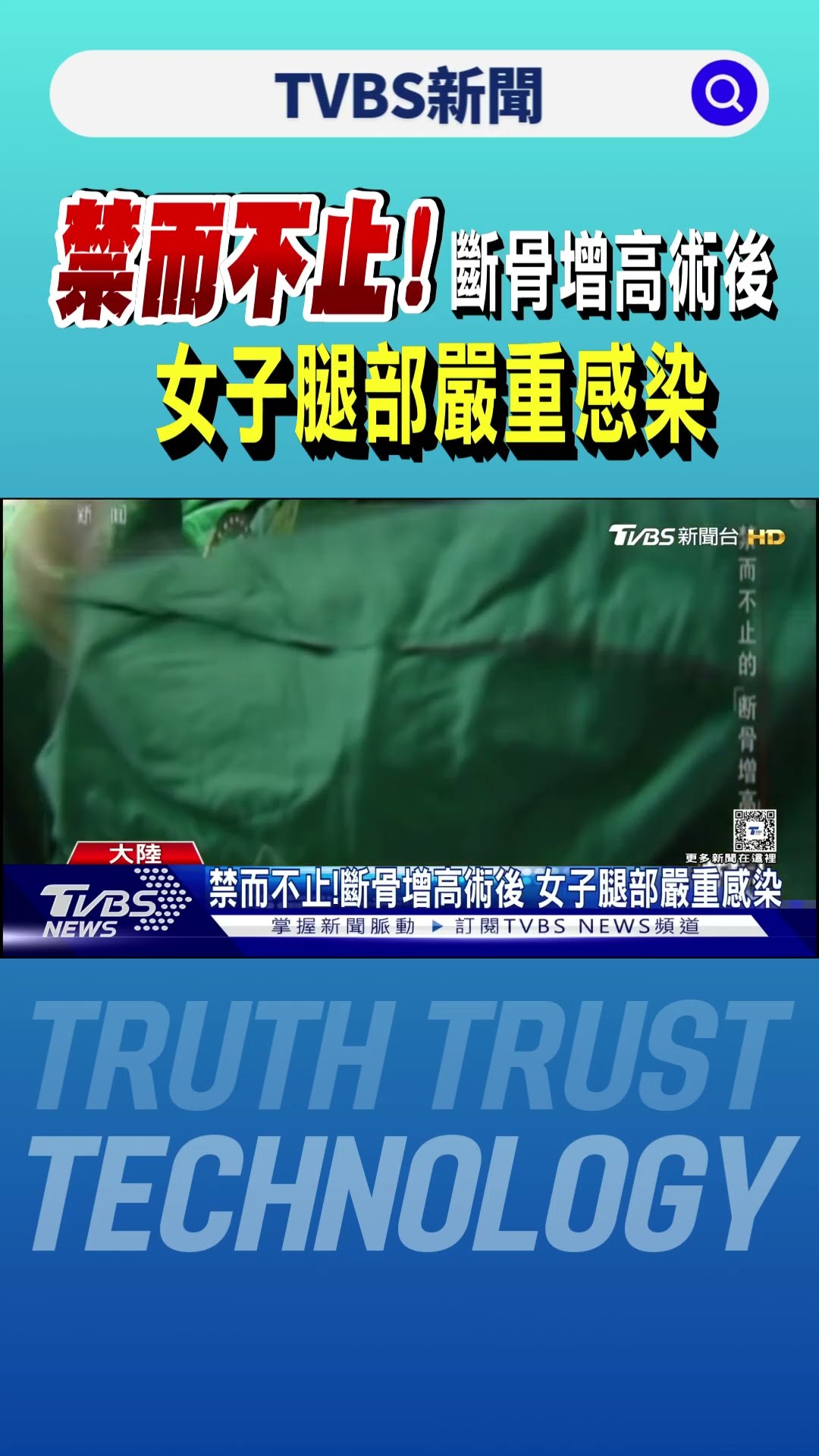 禁而不止!斷骨增高術後 女子腿部嚴重感染｜TVBS新聞 @TVBSNEWS01
