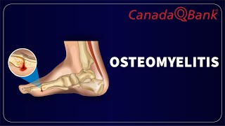 Osteomyelitis by CanadaQBank 1,153 views 1 month ago 8 minutes, 3 seconds