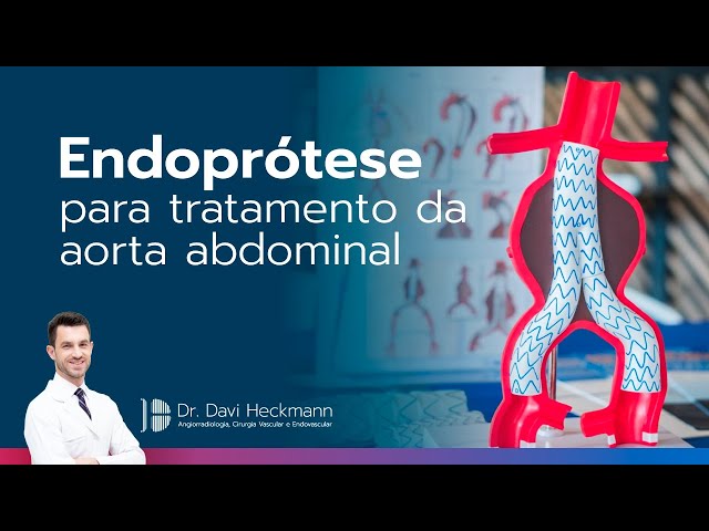 Endoprótese para tratamento da aorta abdominal | Dr. Davi Heckmann