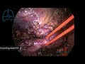 Laparascopic caval (IVC) thrombectomy