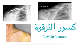 Clavicle fracture (collarbone) / كسور الترقوة