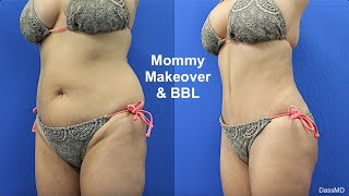 Mommy Makeover - BBL Results - Dr. Dass Beverly Hills