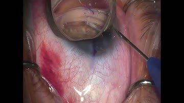 NEW Nova Eye: iTrack Advance GLaucoma surgery