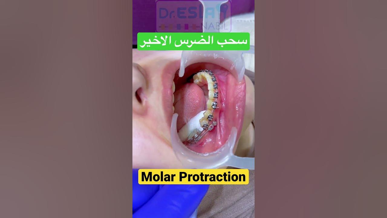 Orthodontic Space closure Molar Protraction YouTube