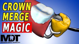 Crown Fit To Partial Digital Design Tutorial Exocad 3.2 [ For Beginner and Beyond ]