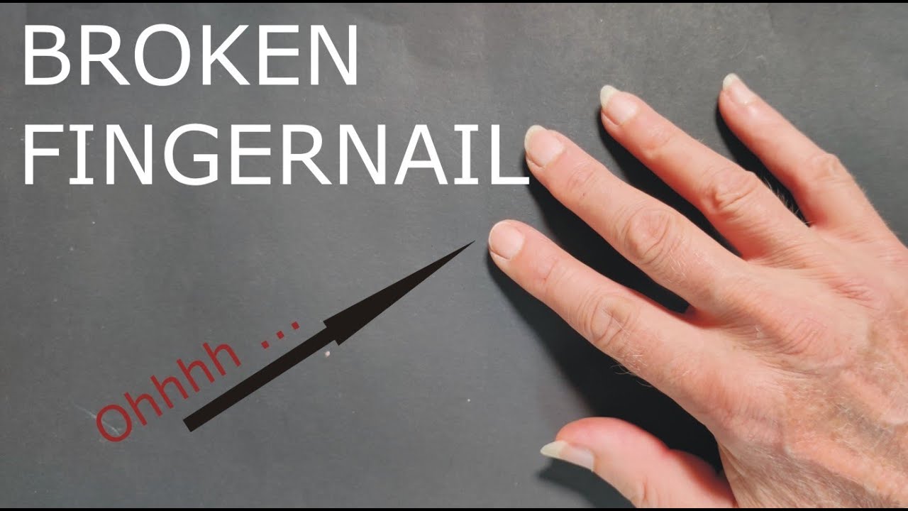 How to fix a broken fingernail (for classical guitar and others)