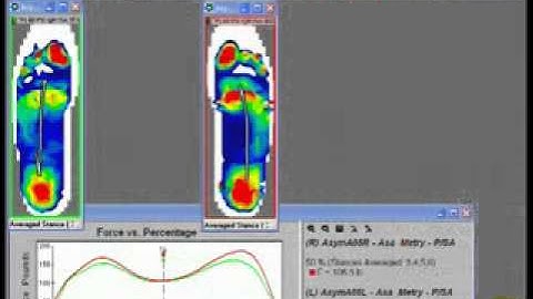 Identifying Asymmetry in Gait Using In-Shoe Pressure Mapping Technology.FLV