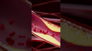 CT Coronary Angiography (CTCA)