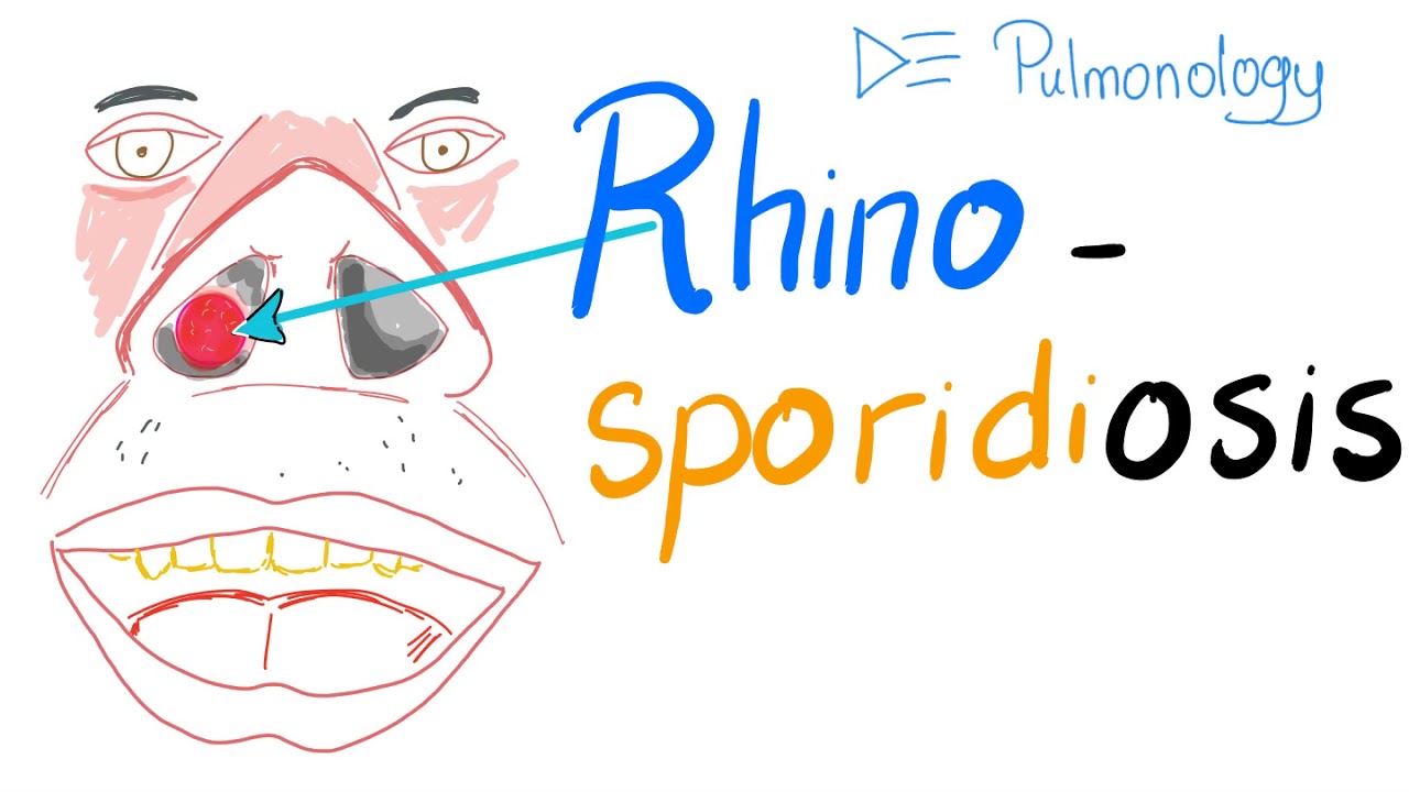Rhinosporidiosis (Rhinosporidium Seeberi) - youtube