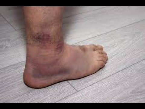 التواء الكاحل و كسر القدم و تمزق الاربطة د عبداللطيف العلوانى استشارى جراحة العظام