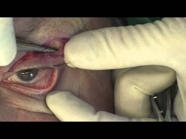 Internal Lateral Canthopexy