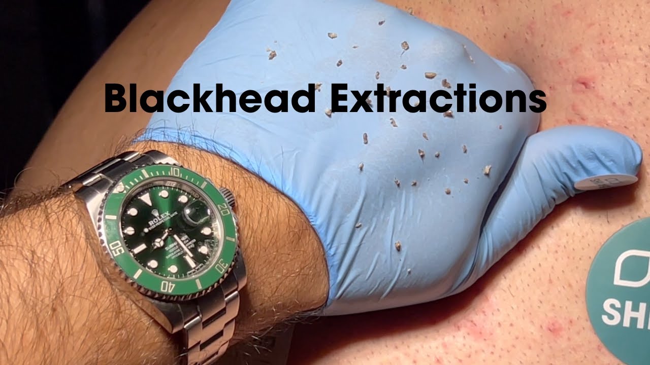 FULL VIDEO Ultimate Blackhead Banishment: Professional Back Extractions Revealed (Blackhead Revenge)