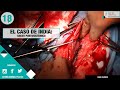 CAPÍTULO 18: 🐶 ¡INDIA tiene un SHUNT de 10mm!