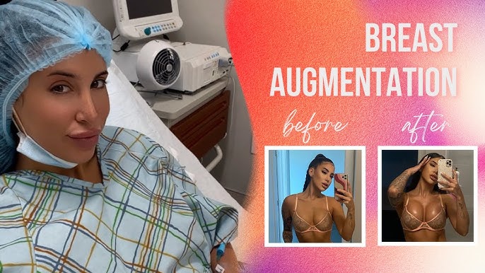 BREAST AUGMENTATION PREPARATION