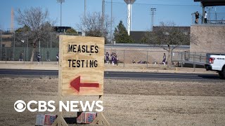 Experts warn of lasting immune effects as measles outbreak spreads
