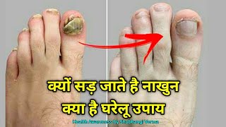 क्यों सड़ जाते है नाखुन क्या है घरेलू उपाय । Nails infection, Nail Fungus, Nails Damage