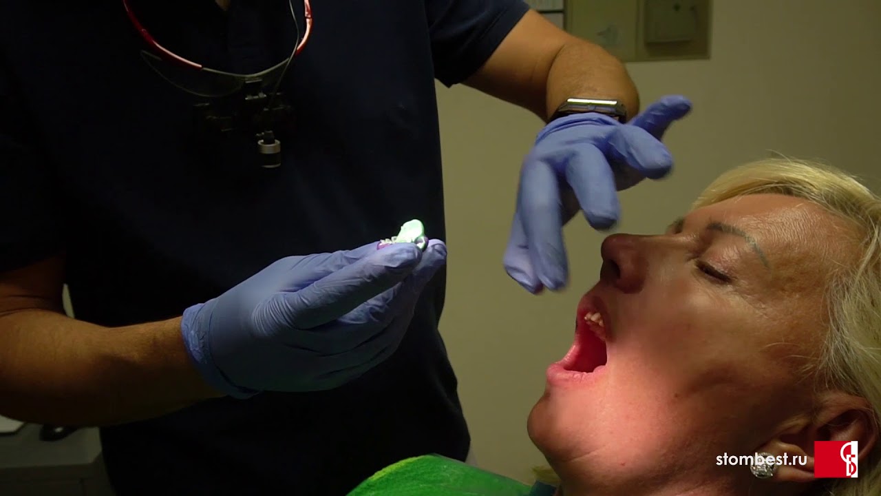 Реальная стоматология! Изготовление временных виниров в клинике 