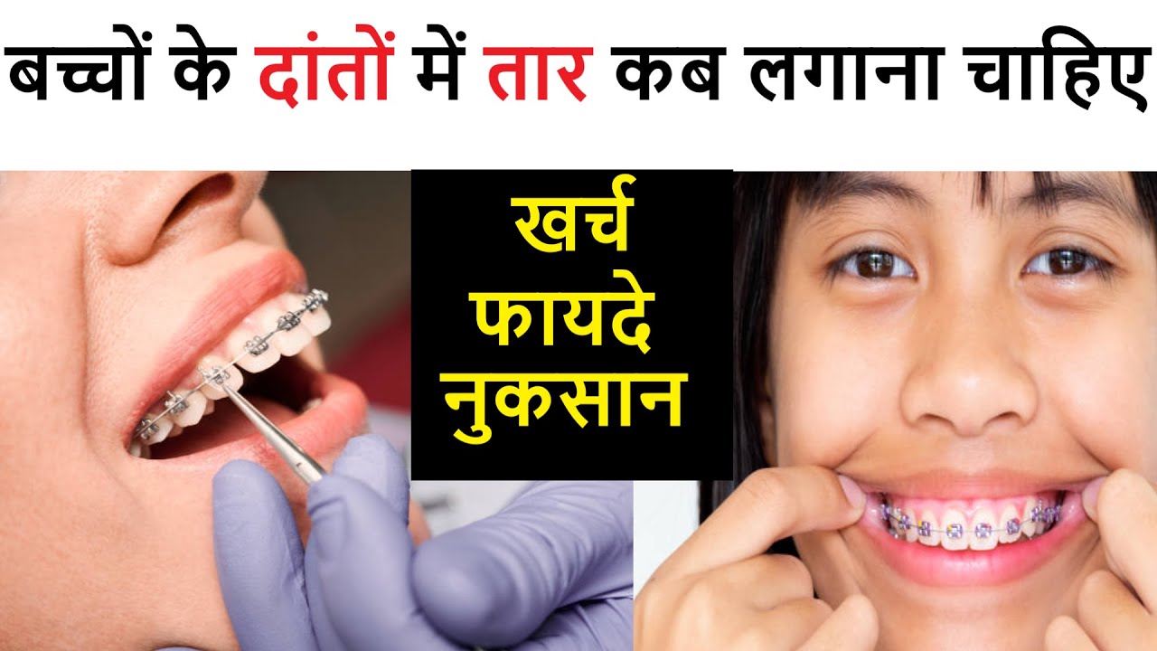 How To put on Dental Braces Step by Step process बच्चों के दांत में