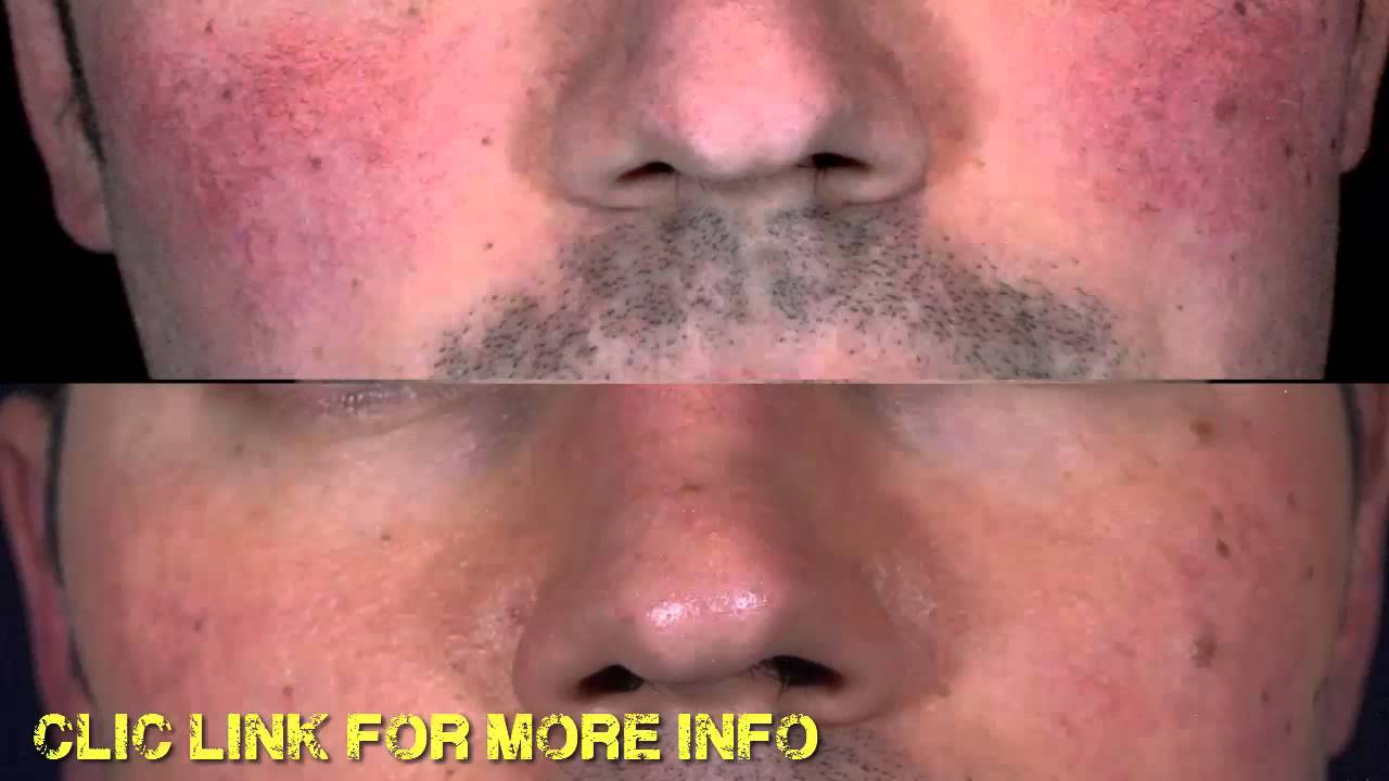 Discussion on this topic: Do You Have Rosacea, do-you-have-rosacea/ Communication on this topic: Do You Have Rosacea, do-you-have-rosacea/