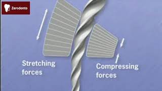 Ni-ti instrument fracture