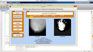Breast Cancer Detection Using Neural Networks Matlab Project with Source Code