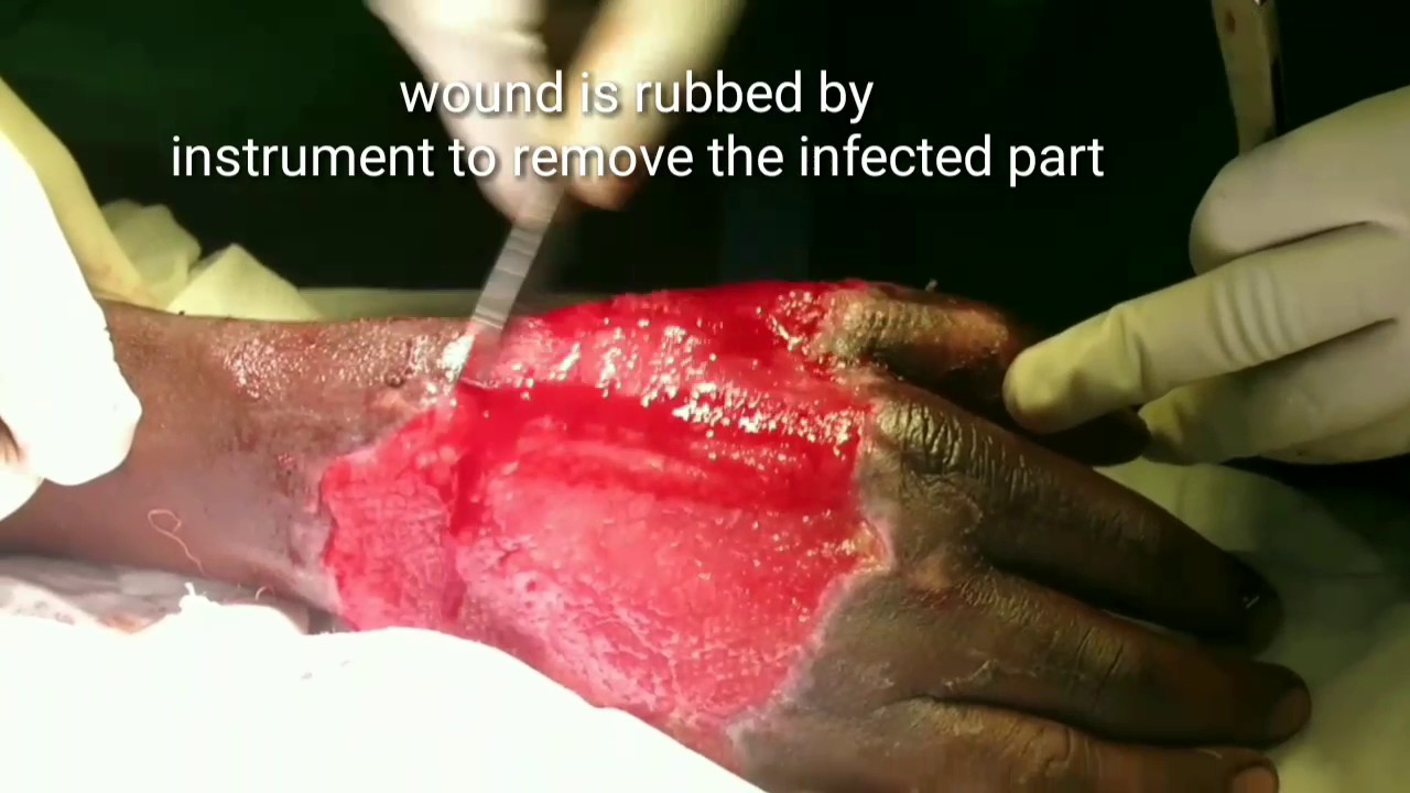 Skin grafting in plastic surgery (full surgery video)