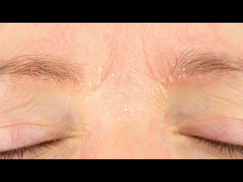 Why Do My Eyebrows Itch and Flake During the Winter?