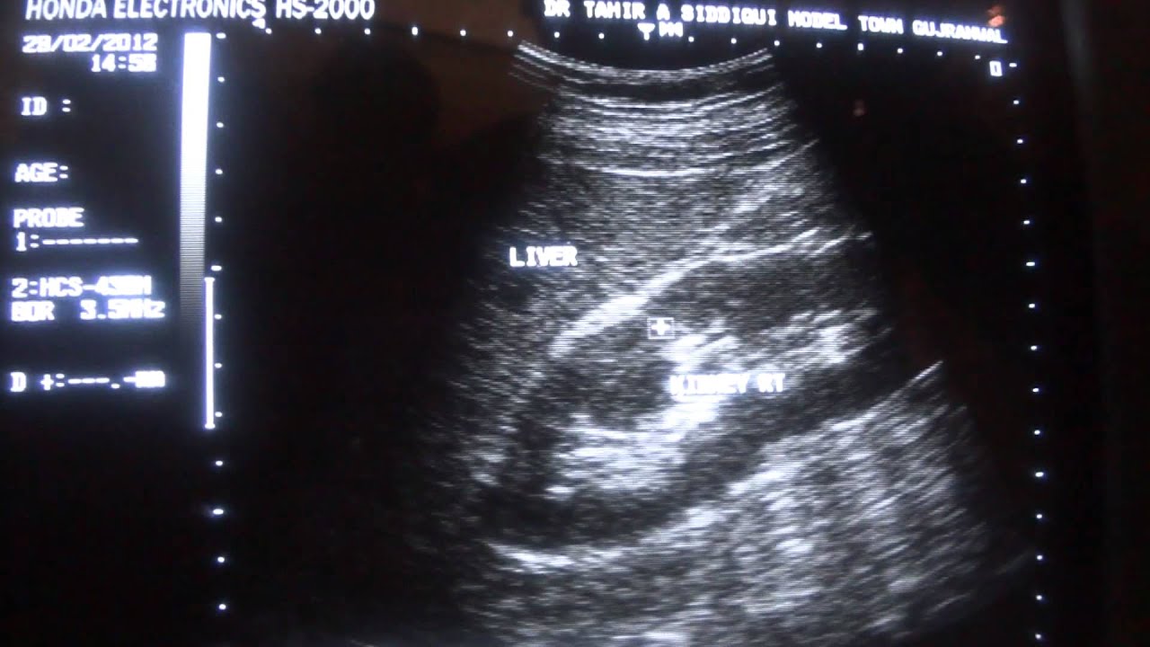 ultrasound study of renal anatomy - YouTube